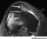 ACL Hamstring