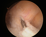 ACL Wire Tibial Footprint