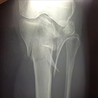 Bicondylar TIB Plateau Fracture