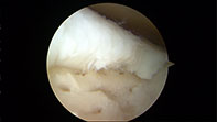 chondral Tibial Flap AND-Microfracture