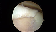Chondral Tibial Flap Microfracture-new