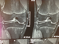 Discoid lateral  Meniscus2