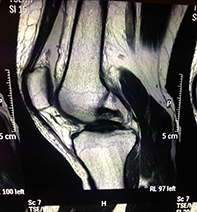 Double Bundle Bucket Handle Medial Meniscus