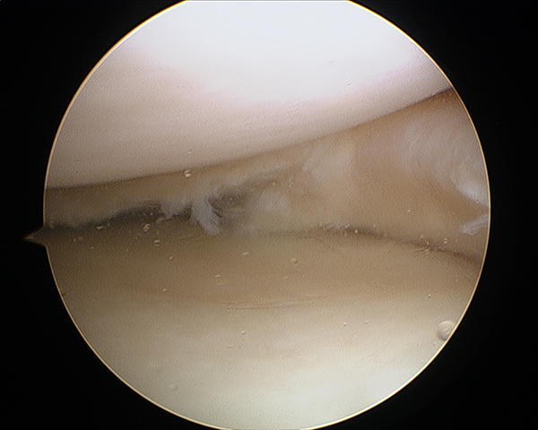 Ligament Injuries Sydney, NSW, ACL, MCL, PCL Tear Randwick