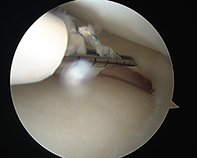 Lateral Meniscal Repair New