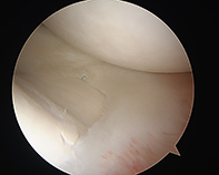 Lateral Meniscal Repair New