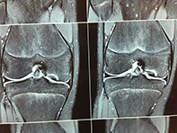 Osteochondral Defect MFC