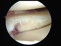 Post Meniscal Debridement