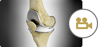 Total Knee Replacement TKR