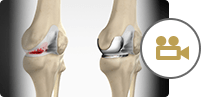 Unicondylar (Unicompartmental) Knee Replacement