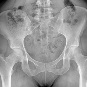 Periacetabular  Osteotomy