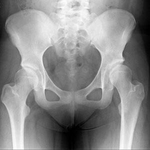 Periacetabular  Osteotomy